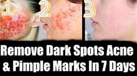 How to Remove Pimple Marks From Face Fast At Home in Hindi