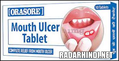 मुंह के छाले की टेबलेट नाम Orasore Mouth Ulcer Tablet